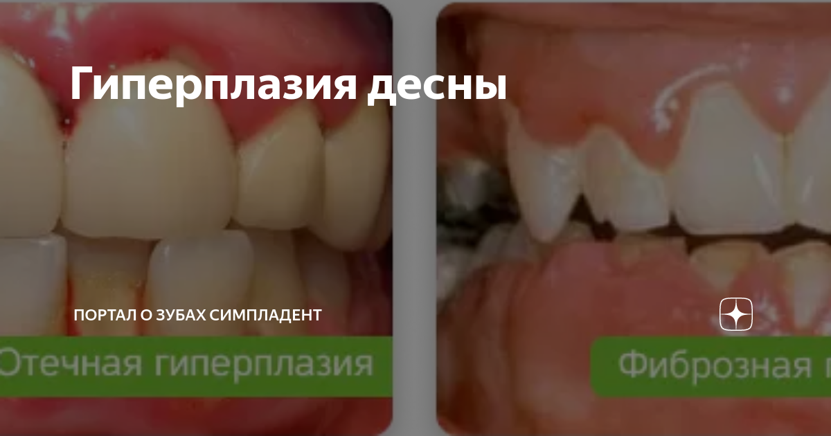 Гиперплазия десны | Портал о зубах Симпладент | Дзен