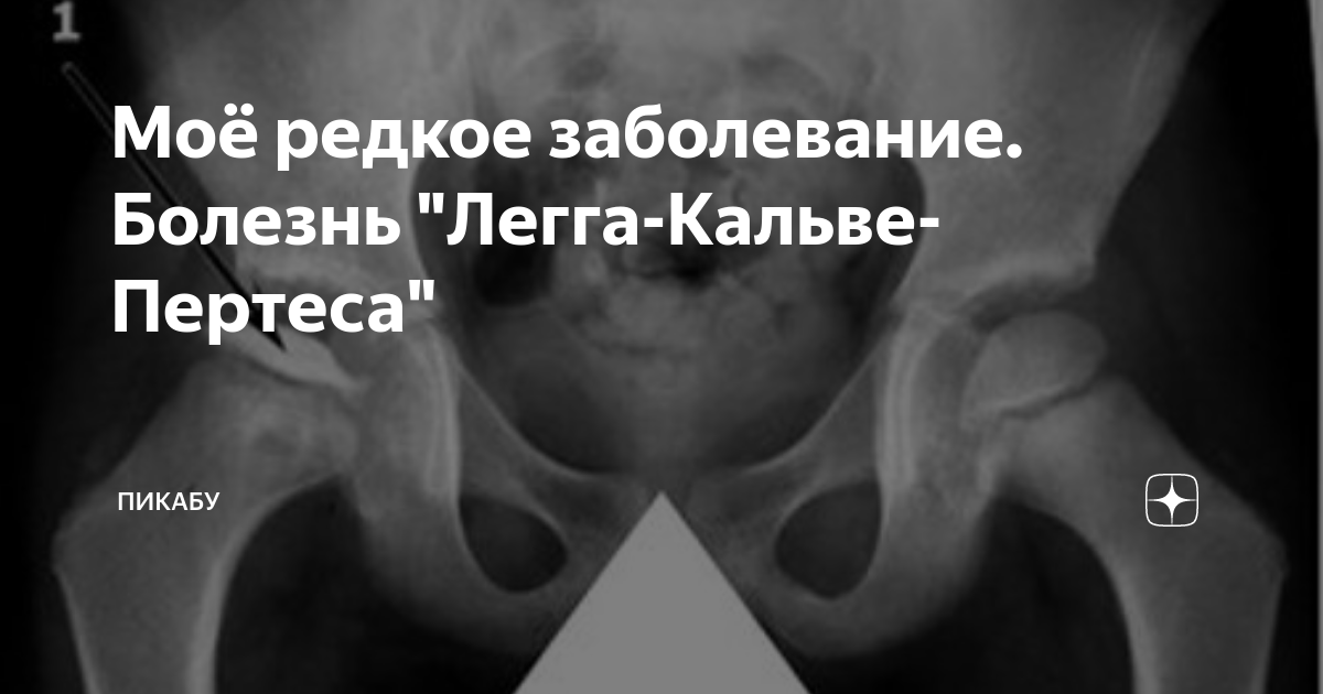 Моё редкое заболевание. Болезнь "Легга-Кальве-Пертеса" | Пикабу | Дзен