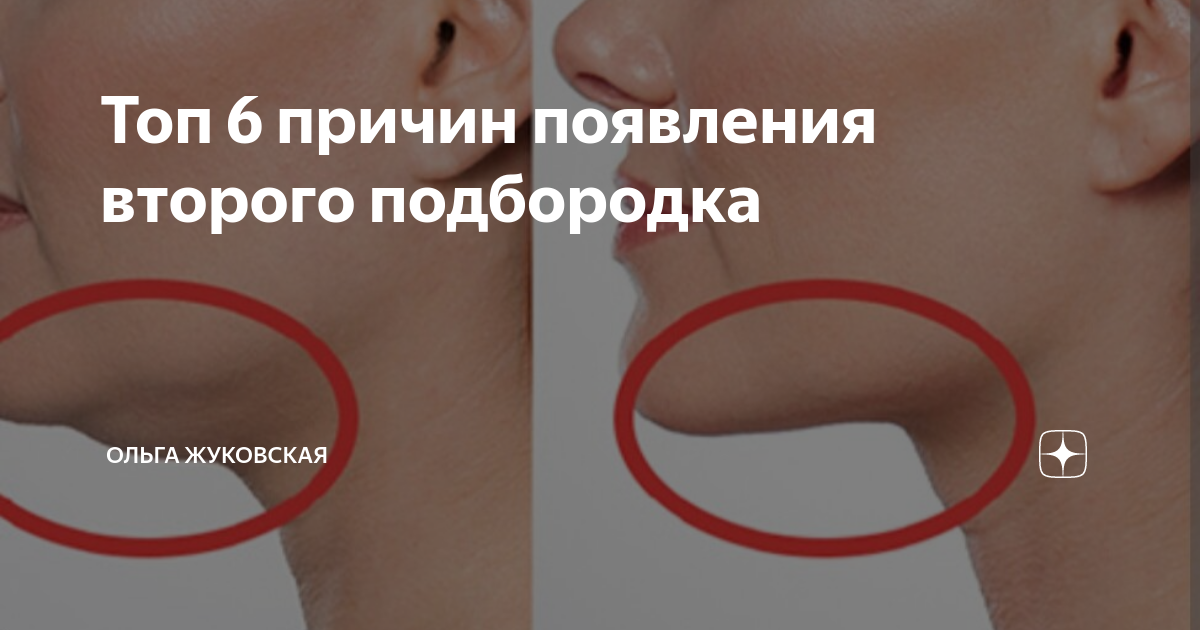 Появление подбородка у человека. Появился второй подбородок. Причины появления второго подбородка. Причины возникновения второго подбородка у женщин. Второй подбородок щитовидка.