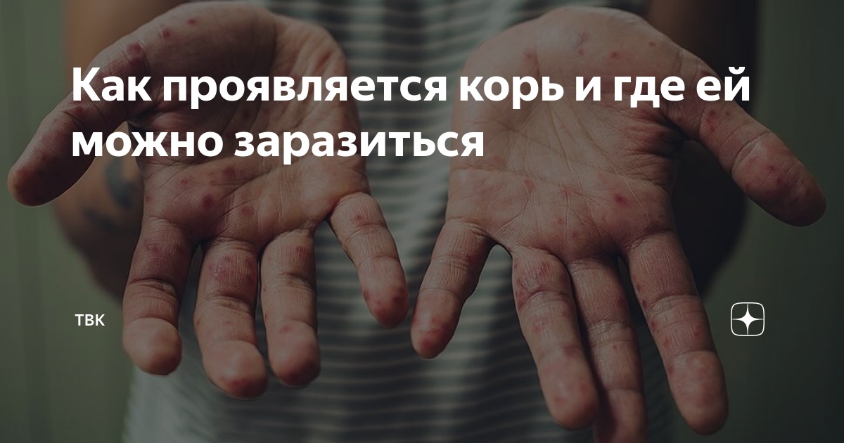 Как проявляется корь и где ей можно заразиться | ТВК | Дзен