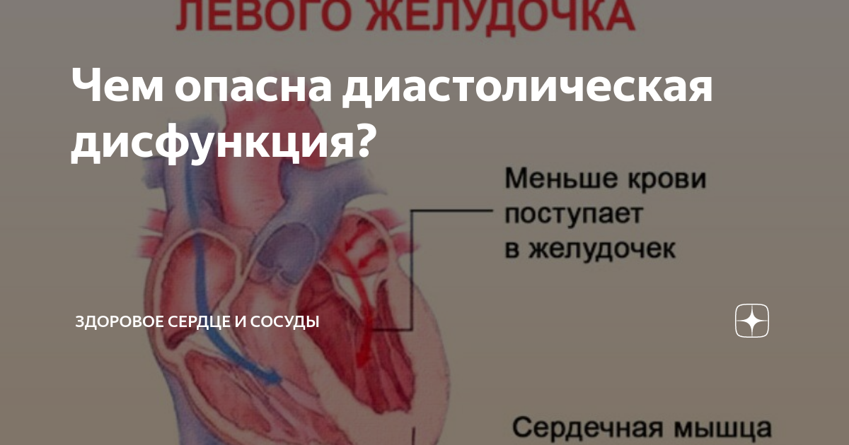 Чем опасна диастолическая дисфункция? | Анна Кореневич | Врач-кардиолог ...