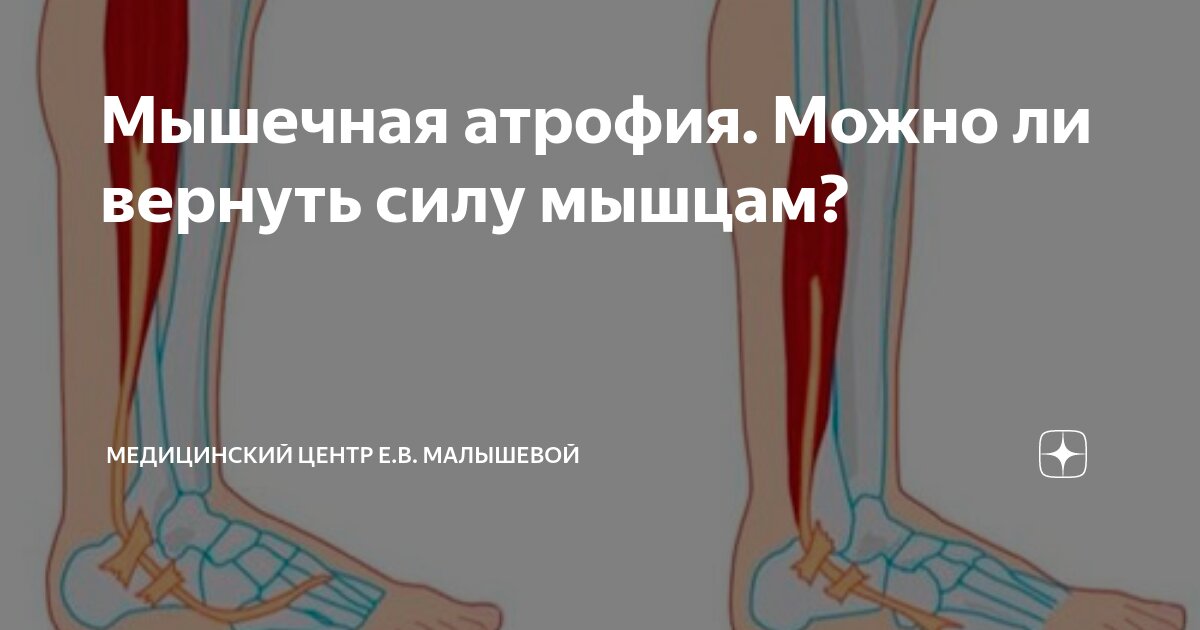 Мышечная атрофия. Можно ли вернуть силу мышцам? | Медицинский центр Е.В ...