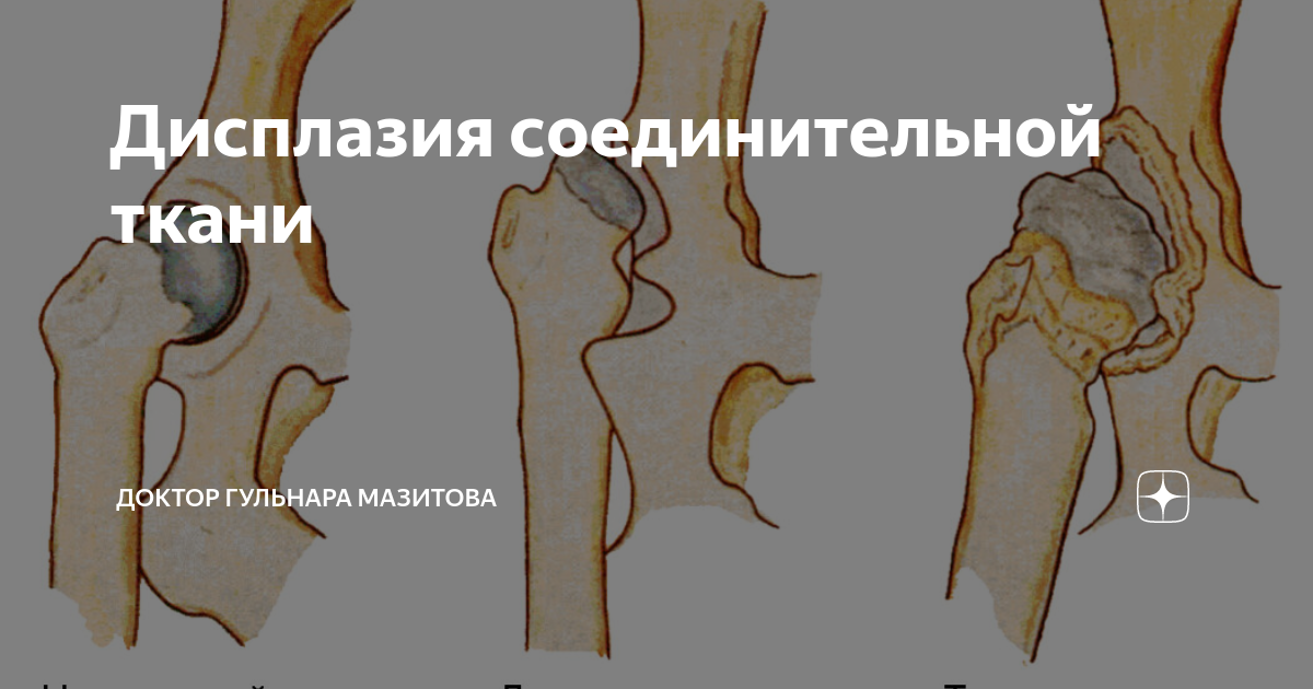 Дисплазия соединительной ткани | Доктор Гульнара Мазитова | Дзен