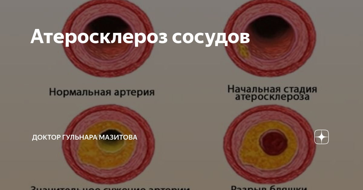 Первичная профилактика атеросклероза сосудов. Атеросклероз сосудов к какому врачу обращаться. Атеросклеротическая бляшка поражает. Атеросклероз сосудов к какому врачу обращаться. Поражение сосудов атеросклерозом.
