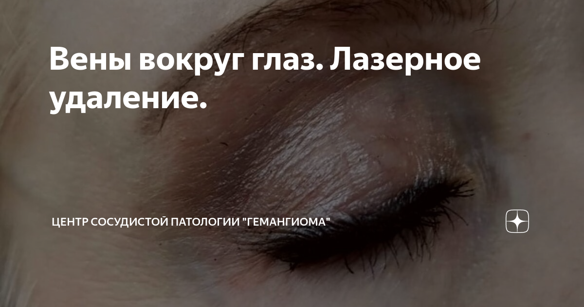 Вены вокруг глаз. Лазерное удаление. | Центр сосудистой патологии ...