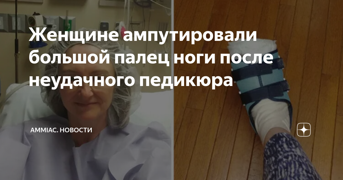 Женщине ампутировали большой палец ноги после неудачного педикюра ...