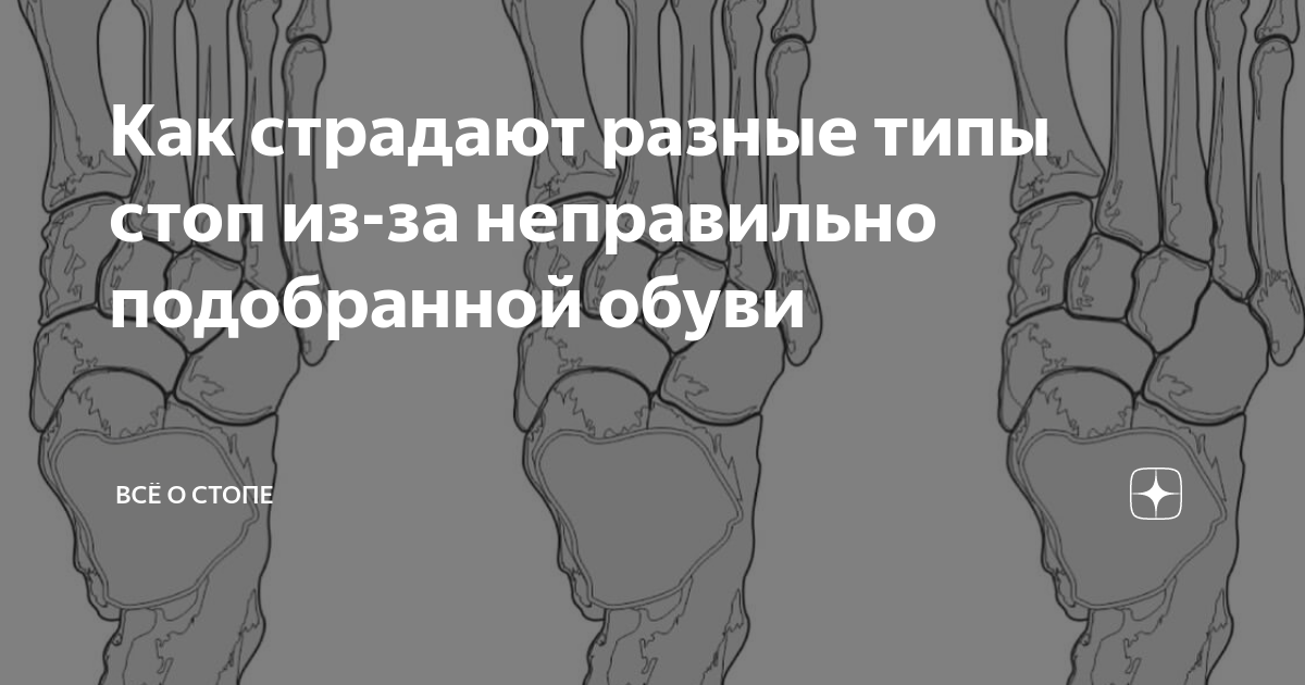 Как страдают разные типы стоп из-за неправильно подобранной обуви | ВСЁ ...