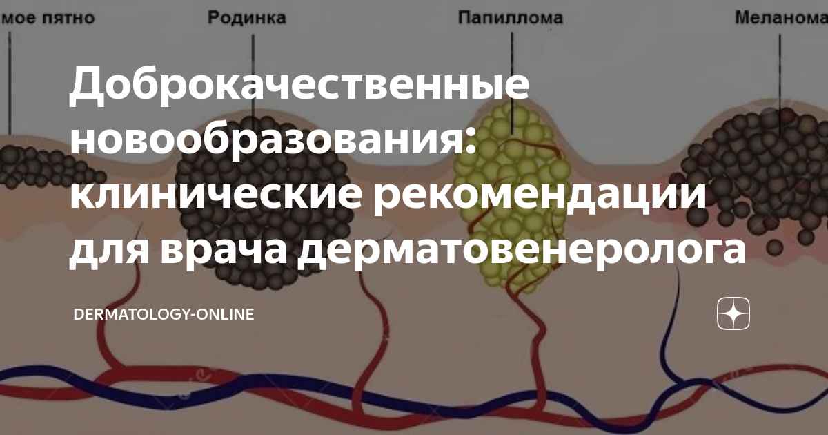 доброкачественные опухоли клинические рекомендации