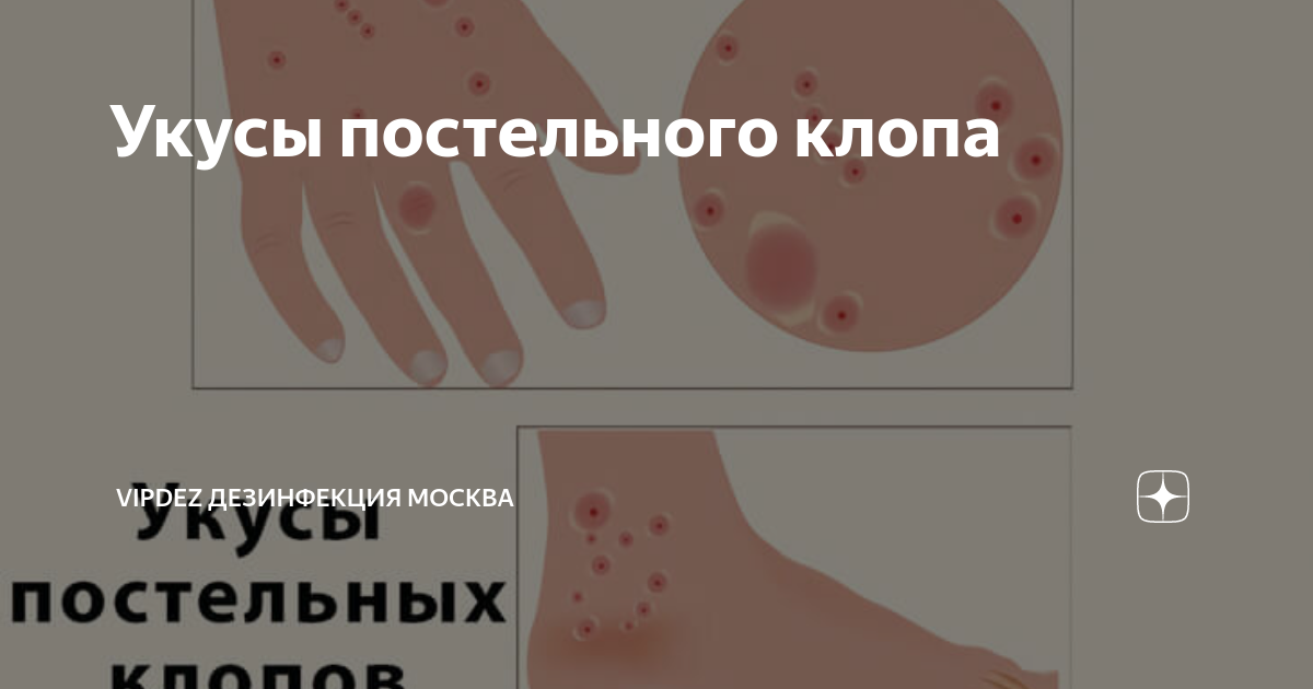 Укусы постельного клопа | VipDez Дезинфекция Москва | Дзен