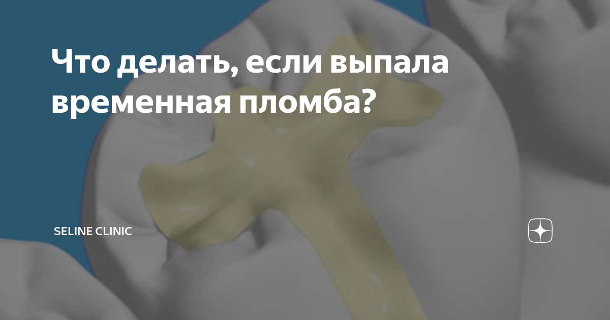 Что делать, если выпала временная пломба? | Seline Clinic | Дзен