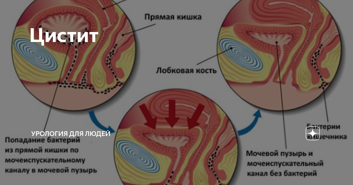 Уретра у женщин расположение при цистите Цистит при беременности симптомы, методы лечения, профилактика