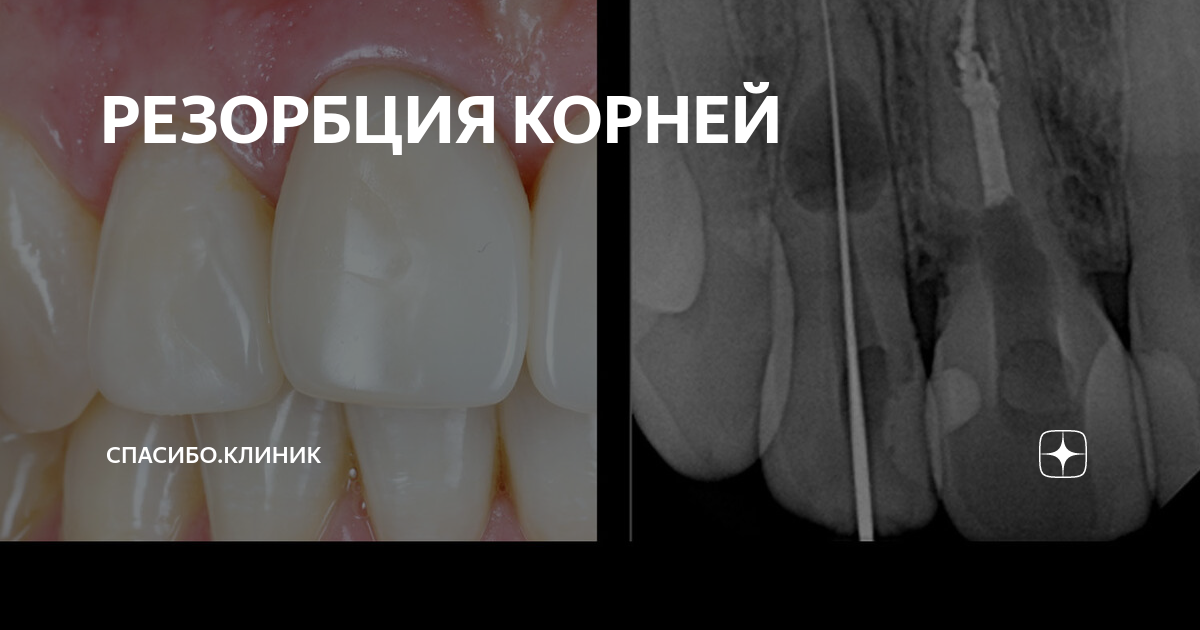 РЕЗОРБЦИЯ КОРНЕЙ | Спасибо.Клиник | Дзен