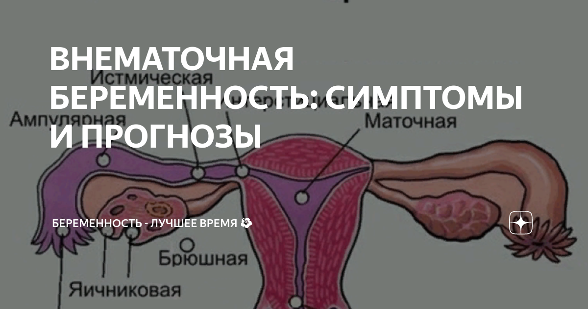 Внематочная беременность: что это, опасно ли для женщины и как этого избежать