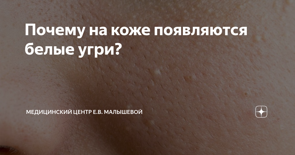 Почему на коже появляются белые угри? | Медицинский центр Е.В ...