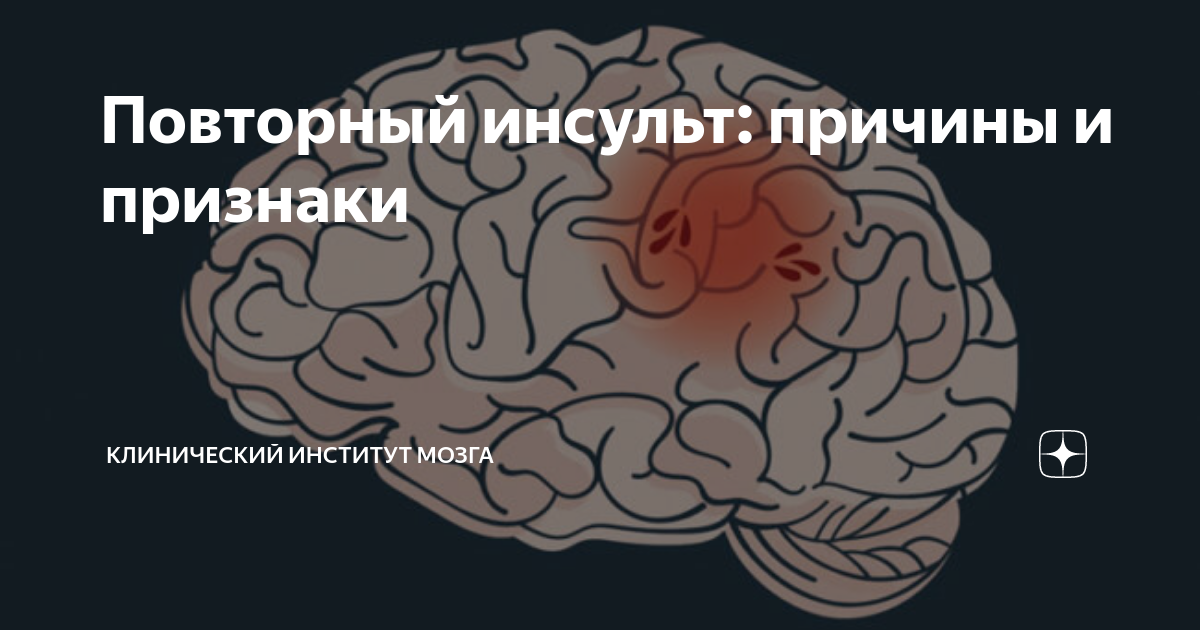 Повторный инсульт прогноз. Повторный инсульт. Деградация мозга институт мозга. Институт мозга Санкт-Петербург.