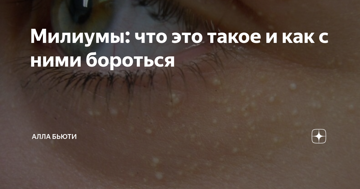 Милиумы: что это такое и как с ними бороться | Алла Бьюти | Дзен