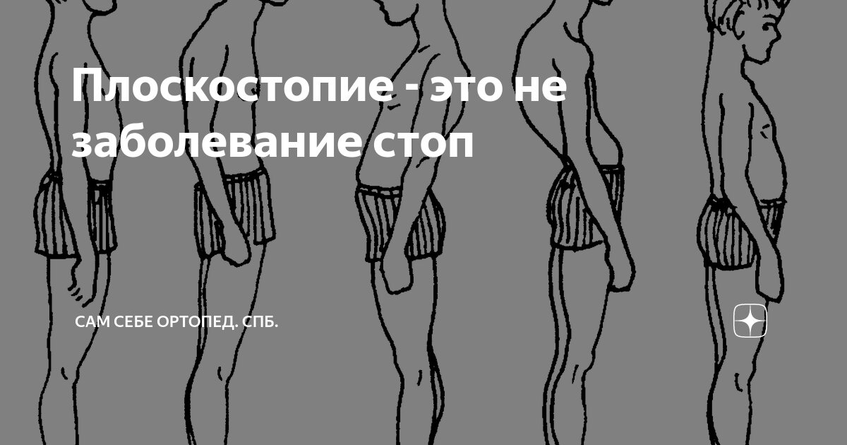 Плоскостопие - это не заболевание стоп | Сам Себе Ортопед. Спб. | Дзен