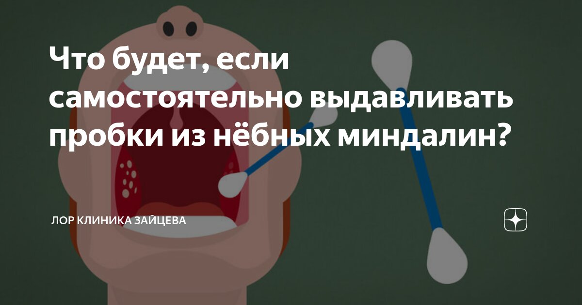 Что будет, если самостоятельно выдавливать пробки из нёбных миндалин ...