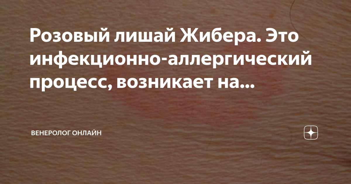 Розовый лишай жибера фото и лечение