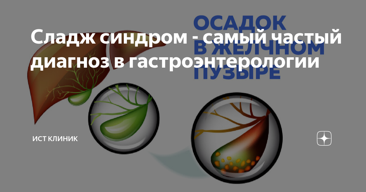 Сладж синдром это. Сладж синдром. Билиарный сладж в желчном пузыре