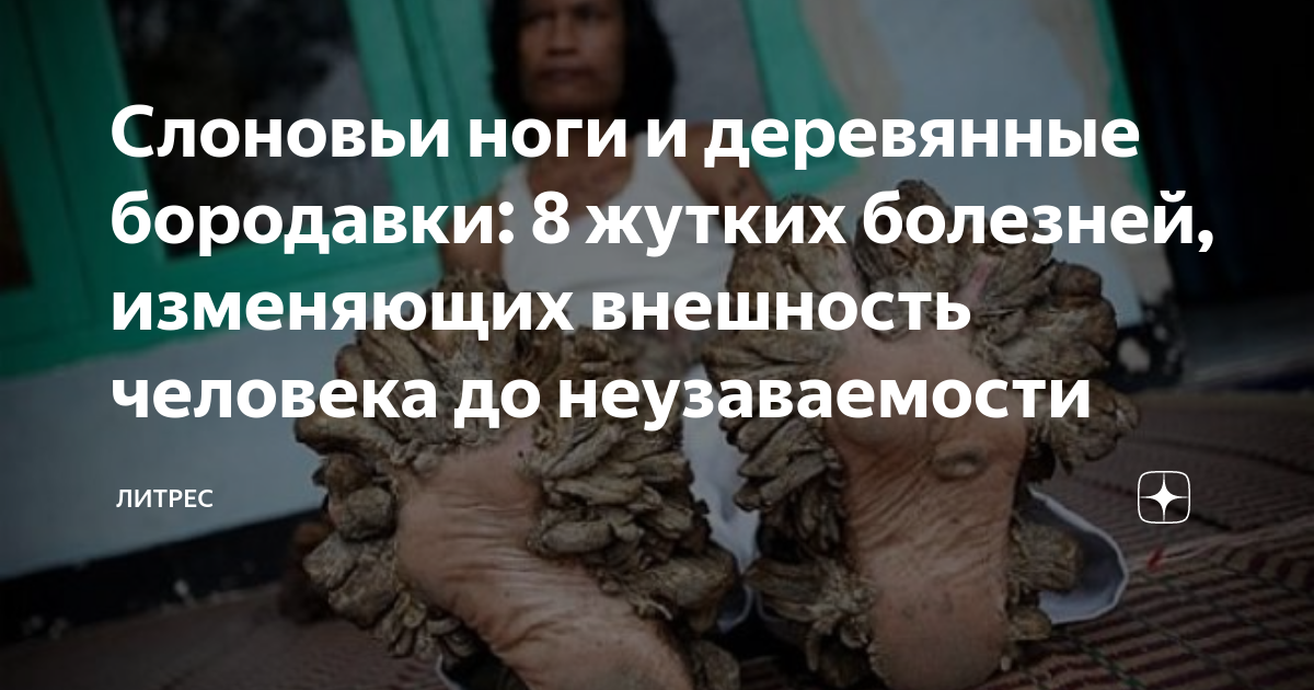 Слоновьи ноги и деревянные бородавки: 8 жутких болезней, изменяющих ...