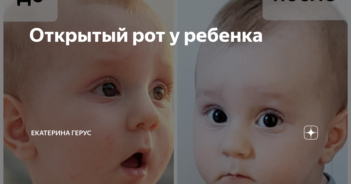 Приоткрыт рот. - 44 ответа - Детское здоровье - Форум Дети gkhyarovoe.ru