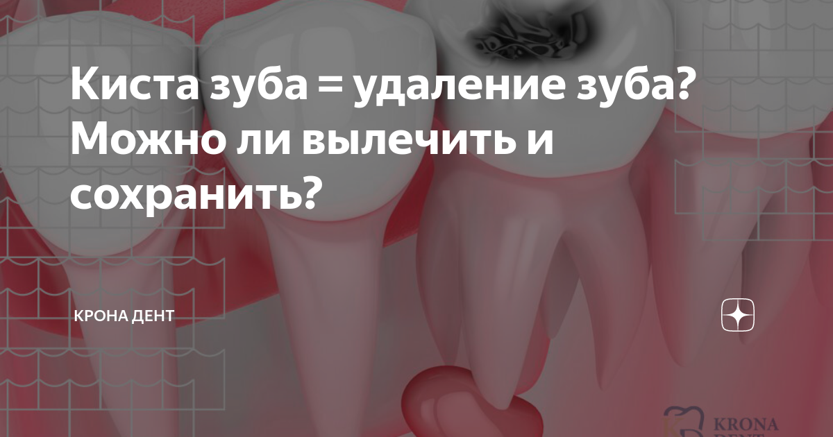 что можно кушать после удаления кисты зуба