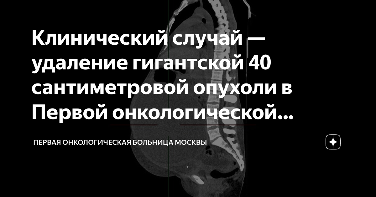 Клинический случай — удаление гигантской 40 сантиметровой опухоли в ...