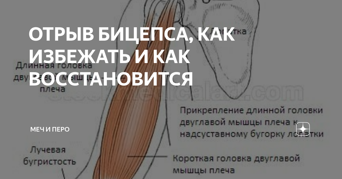 Тендовагинит сухожилия двуглавой мышцы. Тендинит сухожилия бицепса плечевого сустава. Повреждение сухожилия длинной головки бицепса. Сухожилия длинной головки бицепса плечевого сустава. Повреждение сухожилия длинной головки бицепса.