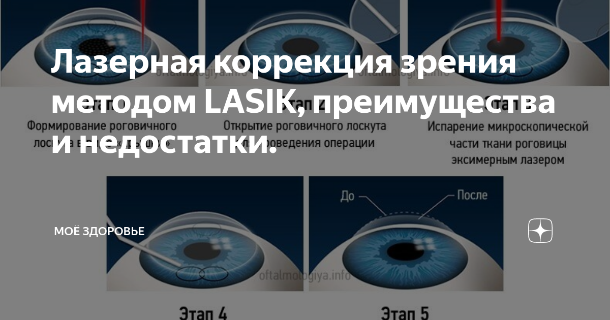 Lasik отзывы лазерная. Коррекция методом ласик. Методы лазерной коррекции. Лазерная коррекция зрения по методу ласик.