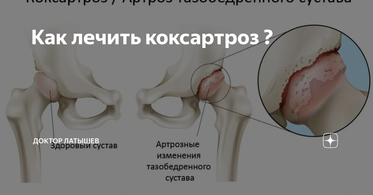 Стадии и симптомы коксартроза