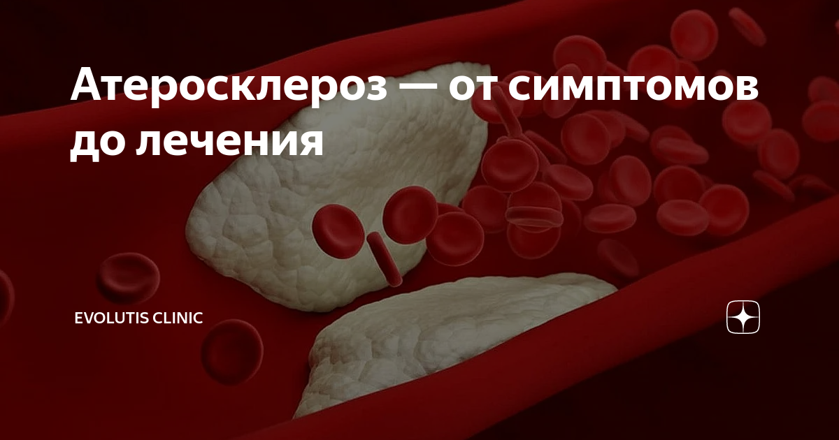 Атеросклероз — от симптомов до лечения | Evolutis Clinic | Дзен