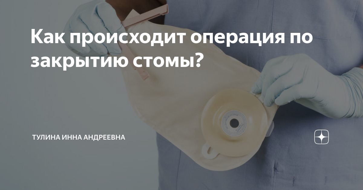 Операция по закрытию стомы. Закрытие стомы у новорожденных. Питание после закрытия стомы.