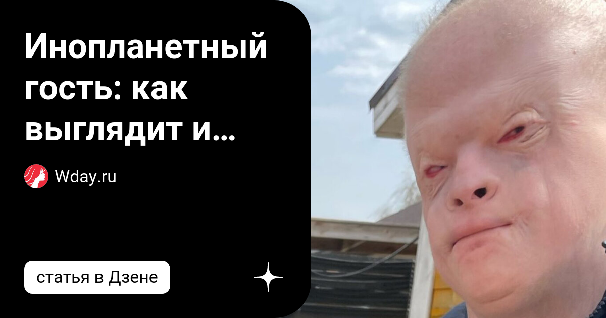 Инопланетный гость: как выглядит и живет 18-летний юноша с редчайшим ...