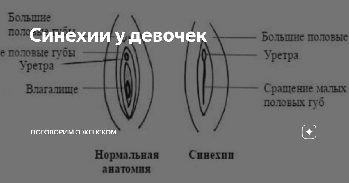 Синехии у девочек