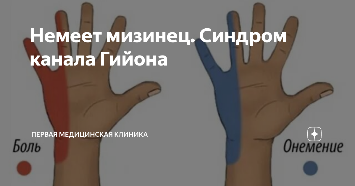 болит левая рука и немеет мизинец