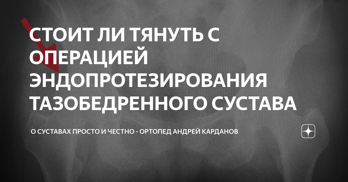 СТОИТ ЛИ ТЯНУТЬ С ОПЕРАЦИЕЙ ЭНДОПРОТЕЗИРОВАНИЯ ТАЗОБЕДРЕННОГО СУСТАВА ...
