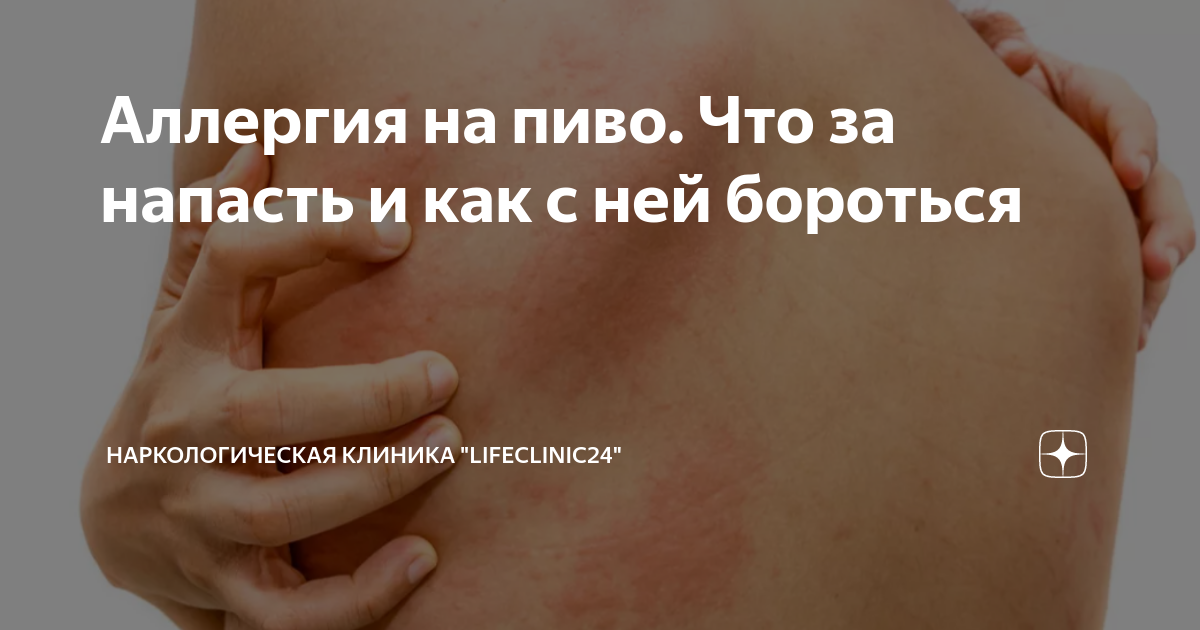 Как выглядит аллергия на спиртное Как алкоголь влияет на аллергию, может ли спиртное обострять аллергическую реакц