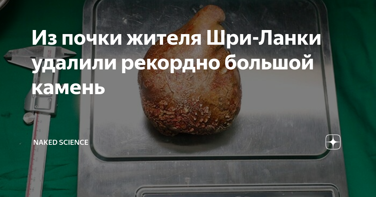 Из почки жителя Шри-Ланки удалили рекордно большой камень | Naked ...