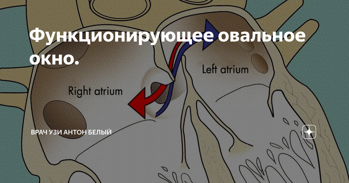 Функционирующее овальное окно. Открытое овальное окно. открытое овал.ное окно. овальное окно в сердце.