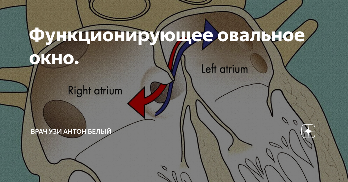 Овальное окно находится между. Функционирующее открытое овальное окно у новорожденных. Открытое овальное окно на УЗИ. Овальное окно в сердце. Незакрытое овальное окно.