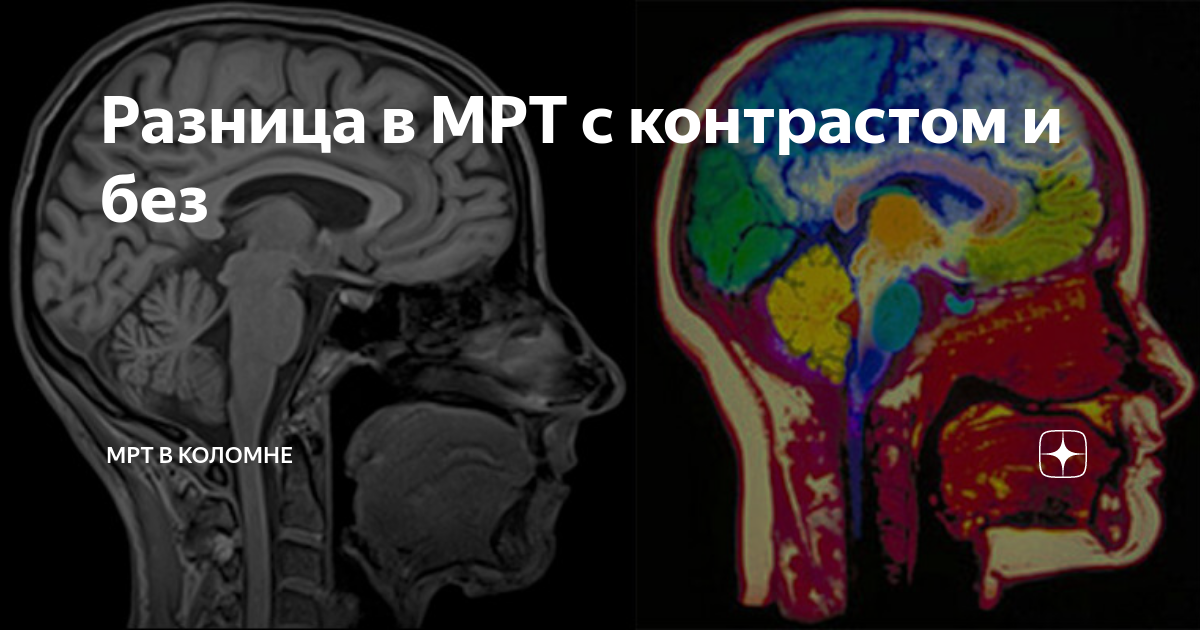 мрт с контрастом и без контраста