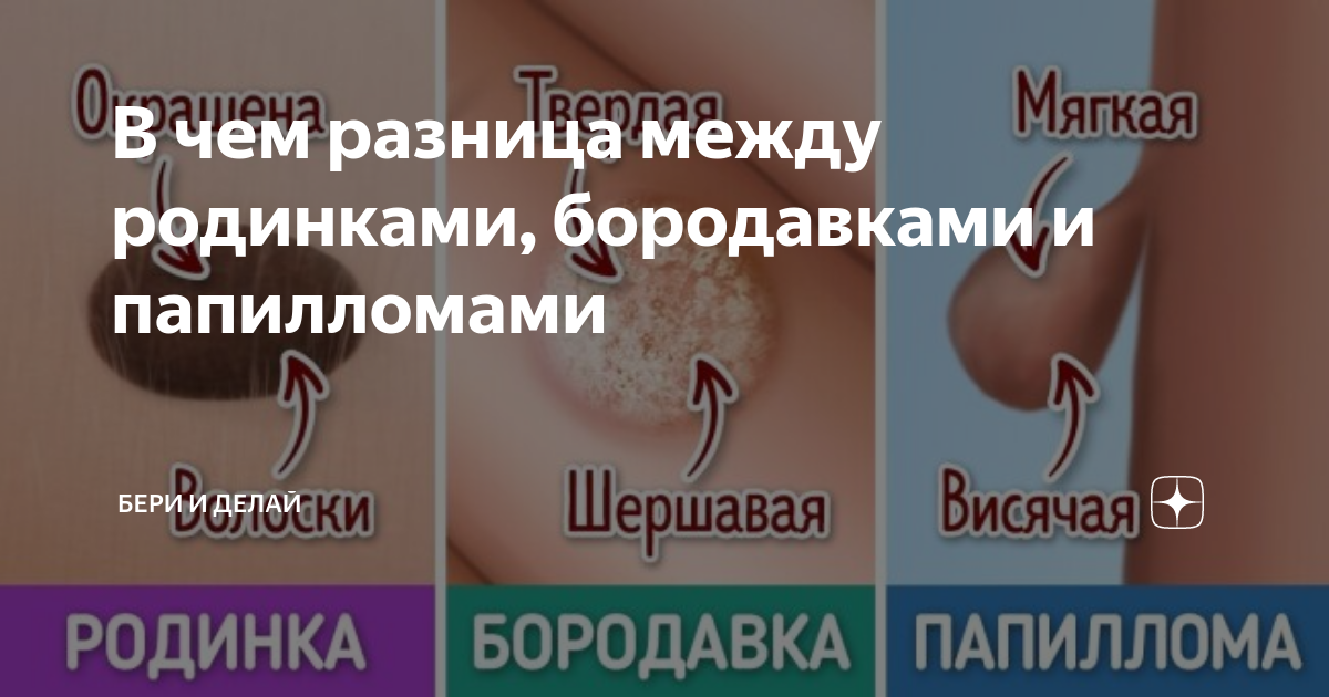 Чем отличается папиллома от бородавки: как возникает заражение, сравнение в теории и на практике