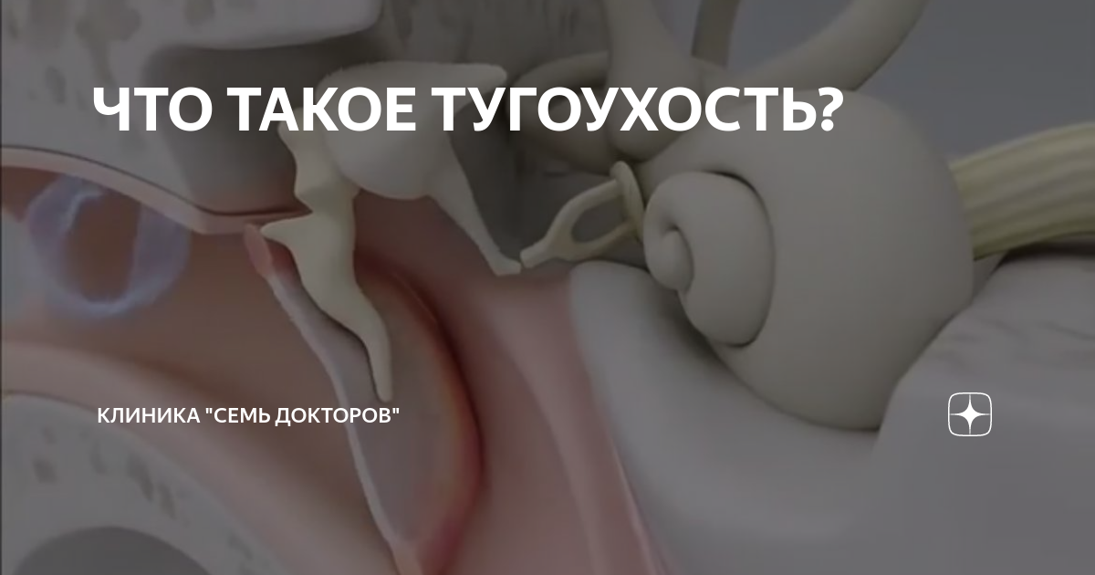 ЧТО ТАКОЕ ТУГОУХОСТЬ? | Клиника "Семь Докторов" | Дзен