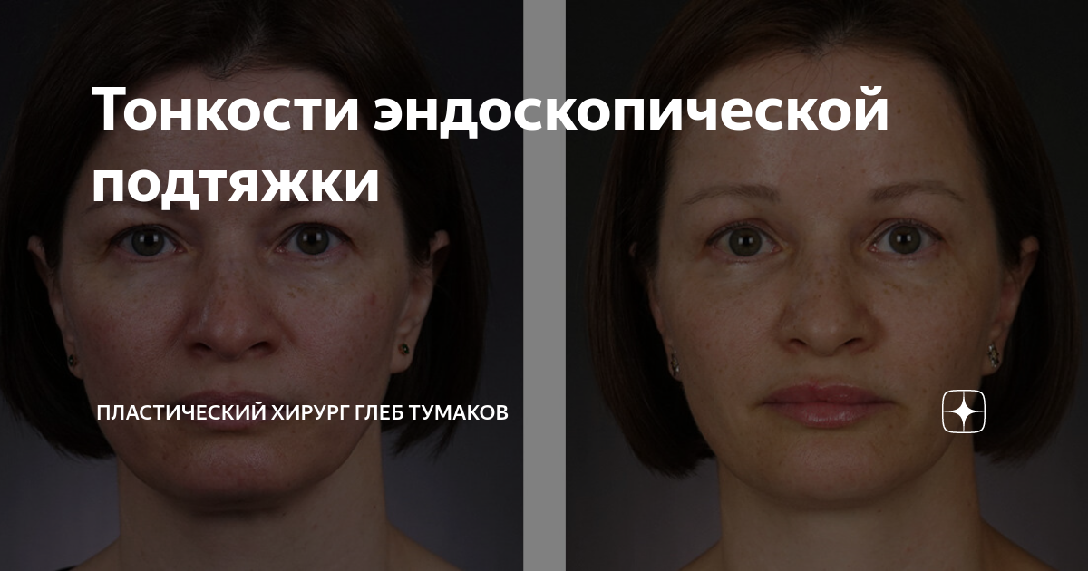 Тонкости эндоскопической подтяжки | Пластический хирург Глеб Тумаков | Дзен
