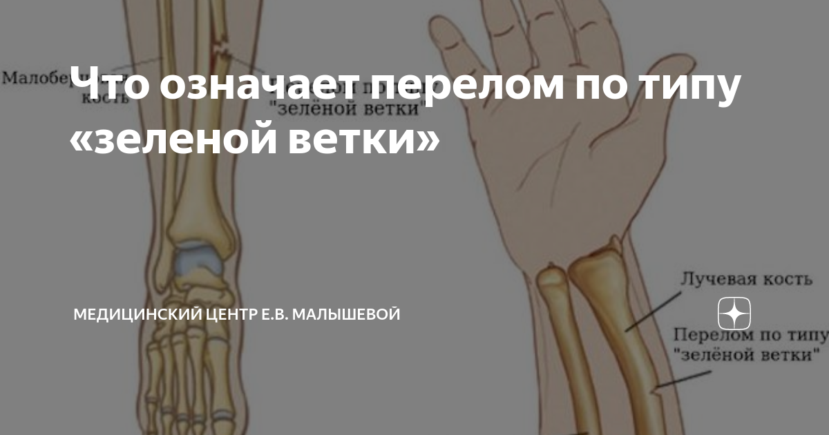 Перелом грудины симптомы. Мягкий язык переламывает кости. Что означает сломать. Сломать человека что означает. Что означает сломать.