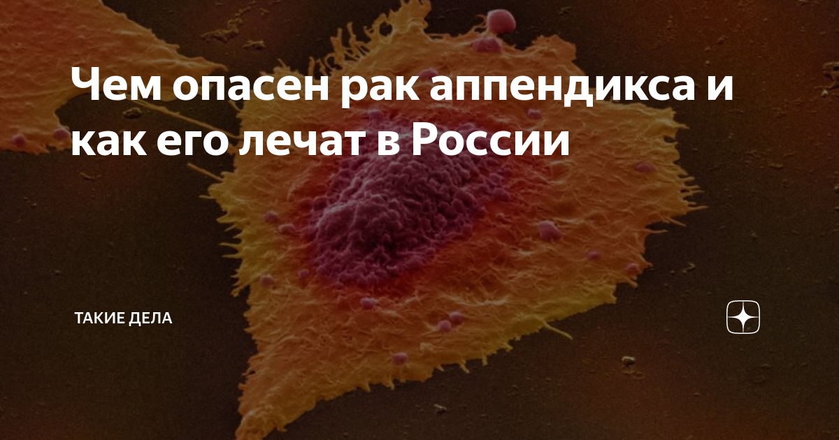 Чем опасен рак аппендикса и как его лечат в России | Такие Дела | Дзен