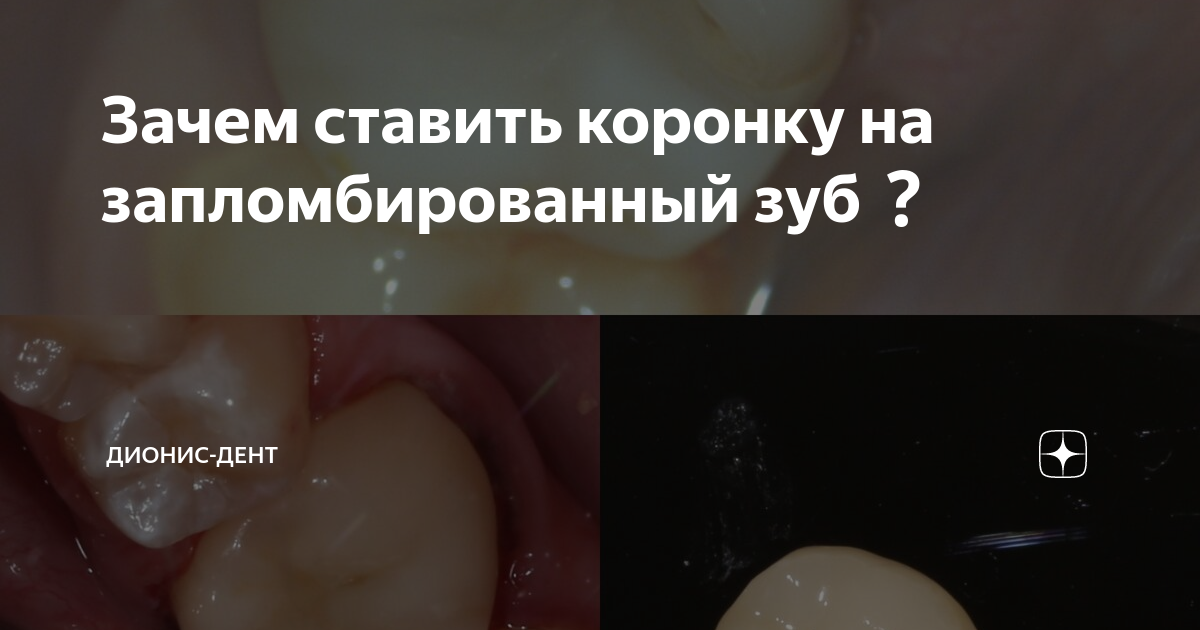 Зачем ставить коронку на запломбированный зуб | Центр стоматологии ...