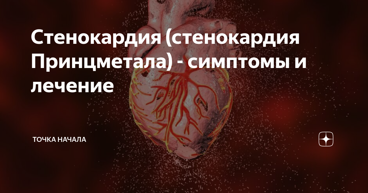 Стенокардия (стенокардия Принцметала) - симптомы и лечение | Точка ...