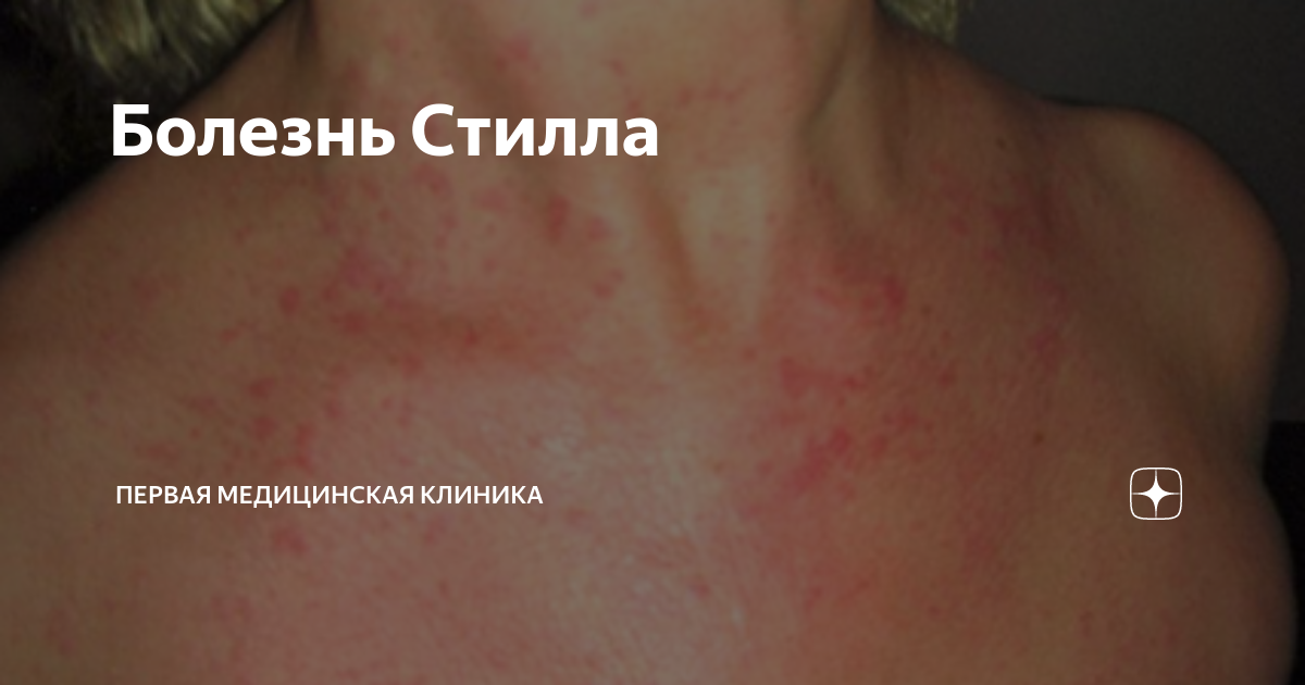 Болезнь Стилла | Первая Медицинская Клиника | Дзен